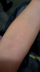 もう、治ってきたかな？