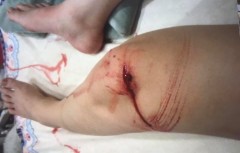 こんな感じの傷ですが（血に弱い方は見ない方がいいですよ）