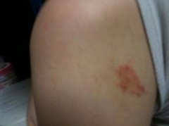 キスマークの思い出