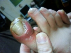 イテテ・・・(￣∇+￣)v