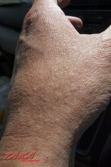 アレルギーの写真を撮ったぞ～！