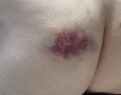 この色でも、青たん？（＞＜）