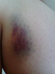 黒あざ(ちょいグロ