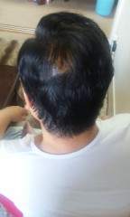 抜糸出来ました