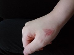 Ｈの際、電気は消す？からの手の火傷