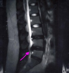 ヘルニア君のその後